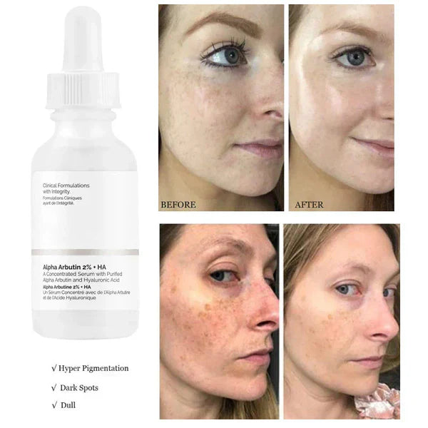 The Ordinary - Alpha Arbutin 2%